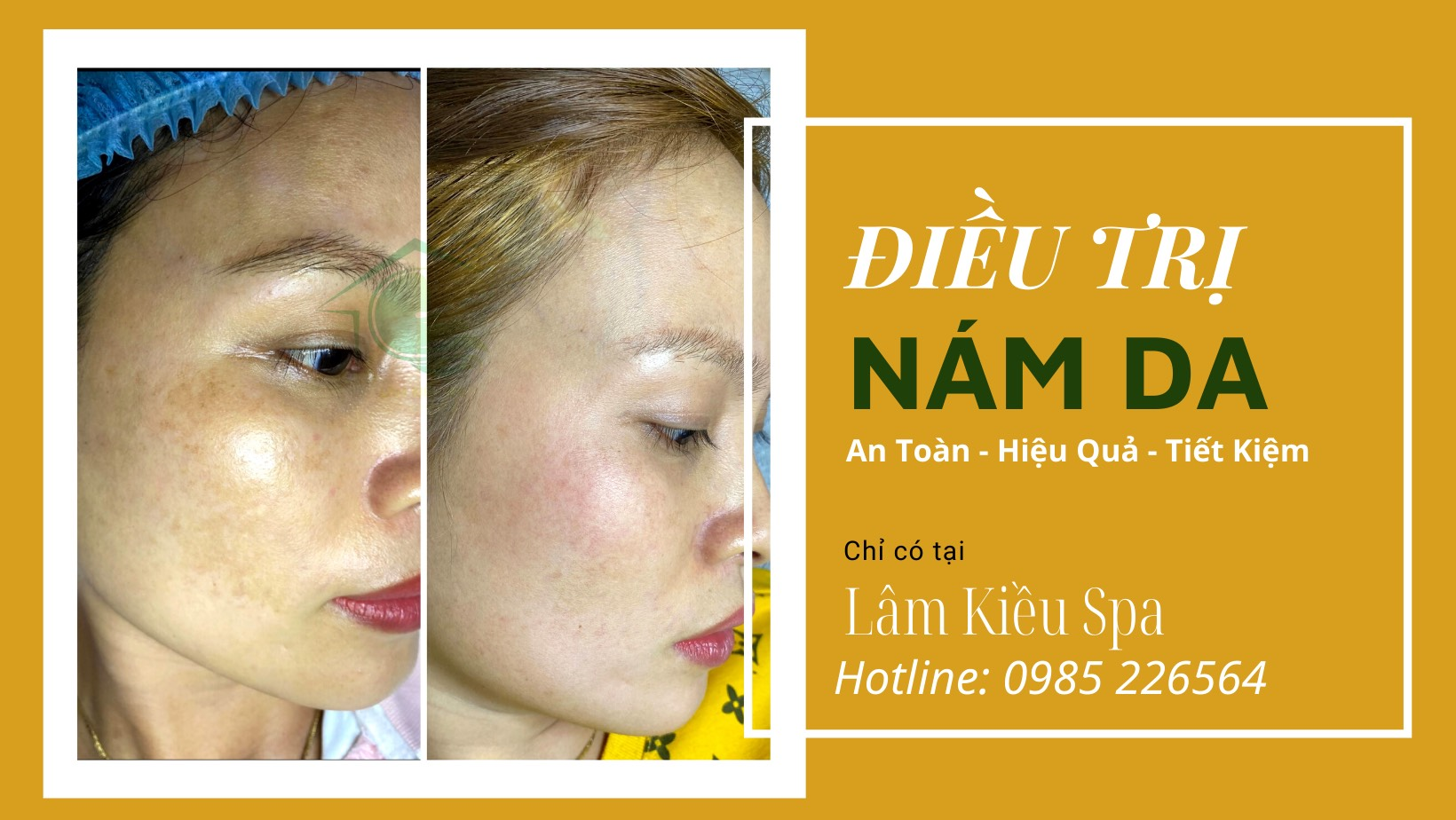 Dịch vụ TRỊ NÁM TÀN NHAN